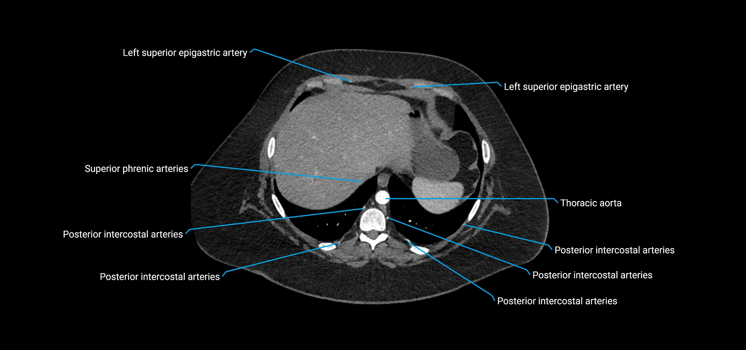 CTA abdomen axial cross sectional anatomy labelled image_22 (2).webp